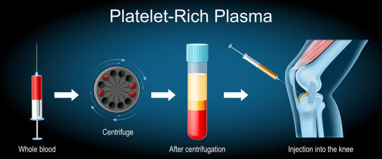 PRP-Therapy's