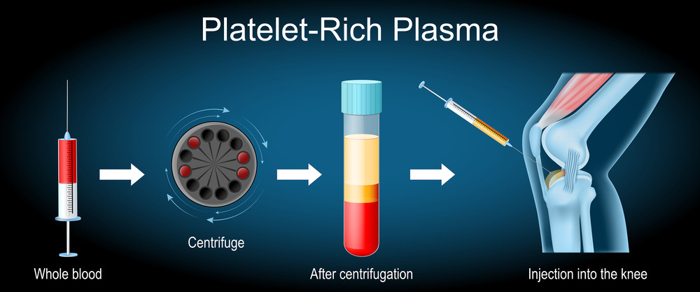 PRP-Therapy's